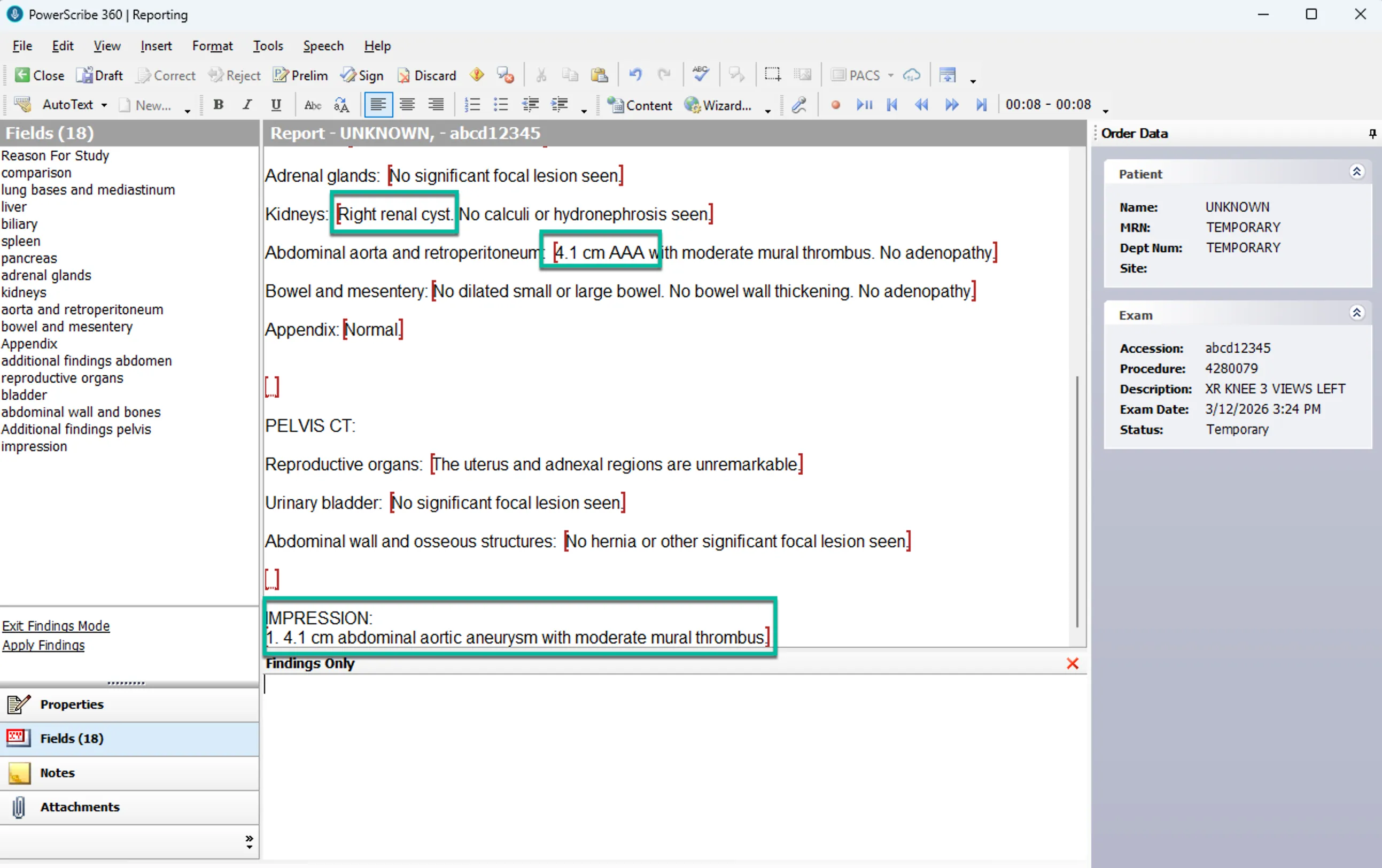 PowerScribe report after merge showing findings placed in template fields and auto-generated impression