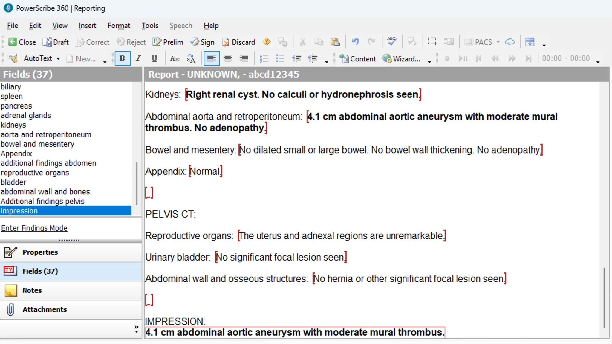 PowerScribe report after merge showing findings placed in template fields and auto-generated impression
